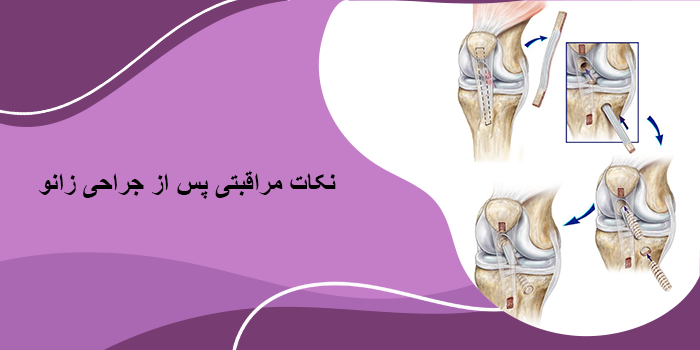 نکات مراقبتی پس از جراحی زانو