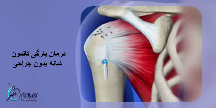 درمان پارگی تاندون شانه بدون جراحی