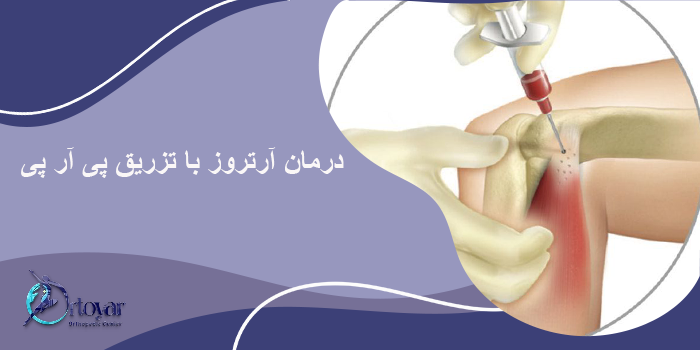 درمان آرتروز با تزریق پی آر پی