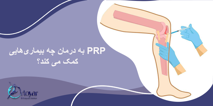 مزایای استفاده از پی آر پی برای درمان آرتروز