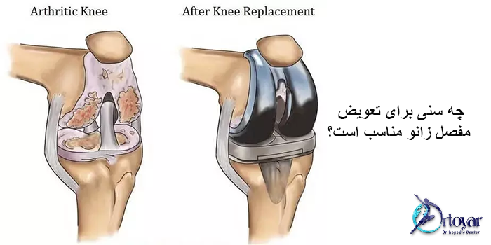 سن مناسب تعویض مفصل زانو