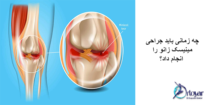 مدت زمان بهبودی پس از جراحی مینیسک زانو