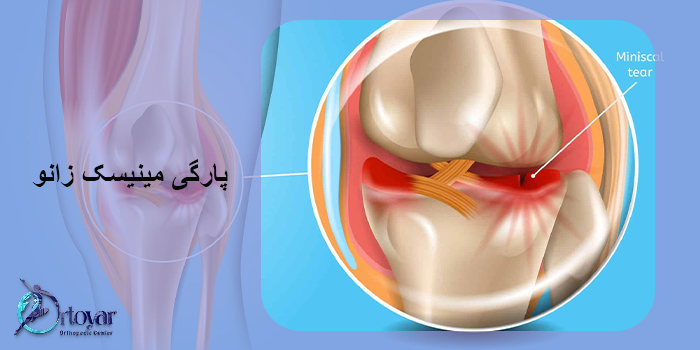 پارگی مینیسک زانو