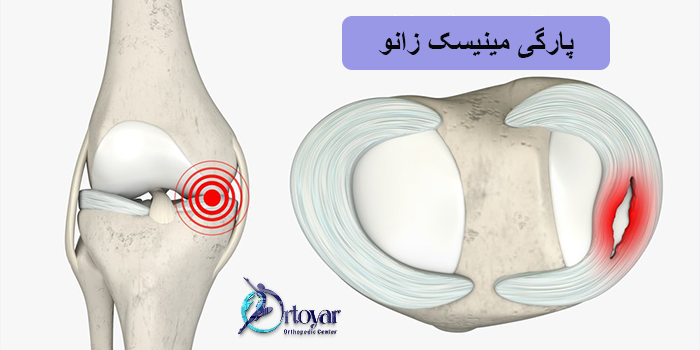 پارگی مینیسک زانو