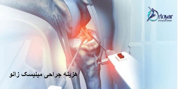 هزینه جراحی مینیسک زانو