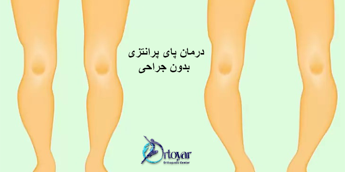درمان پای پرانتزی بدون جراحی
