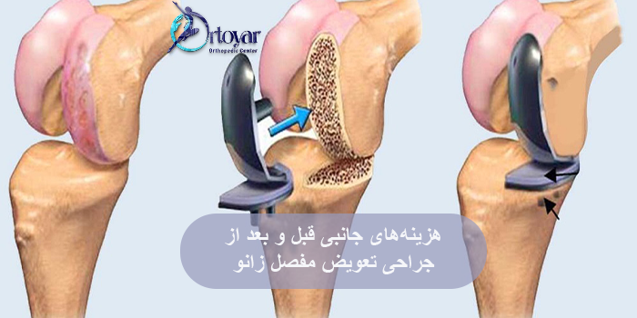 هزینههای جانبی قبل و بعد از جراحی تعویض مفصل زانو