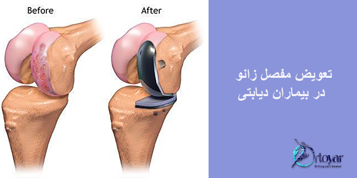 تعویض مفصل زانو در بیماران دیابتی